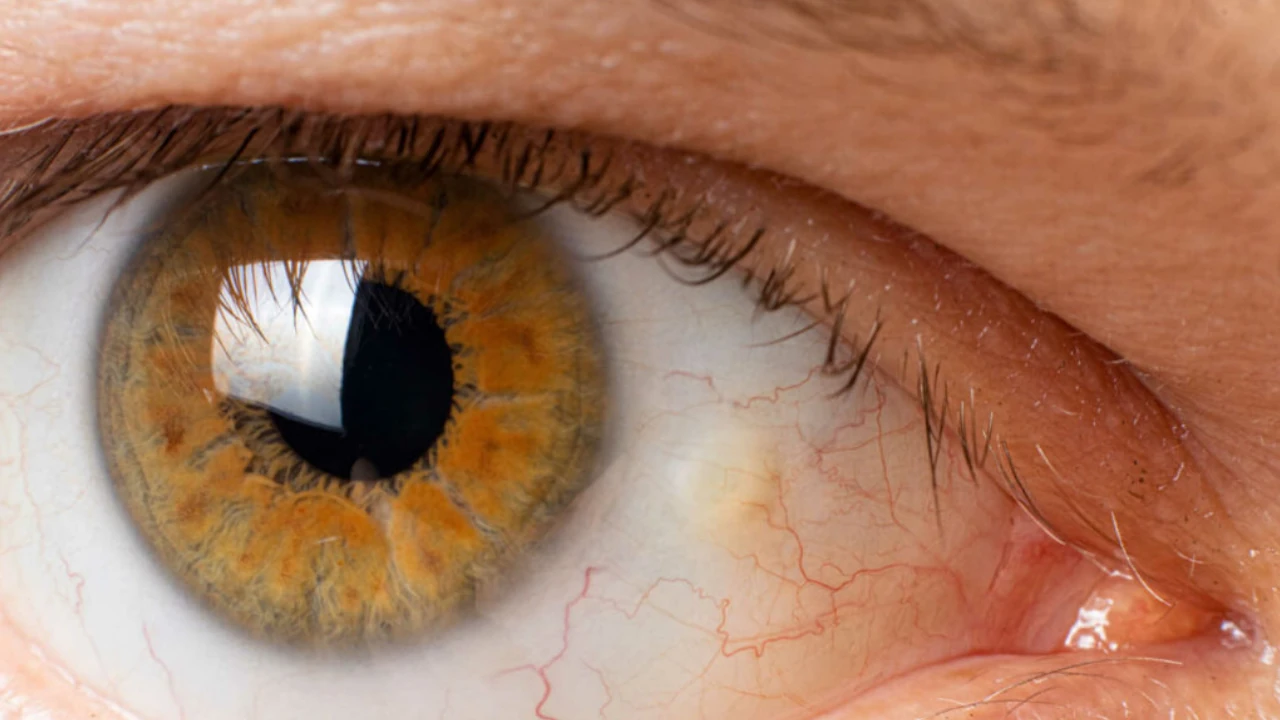 What You Should Know About Corneal Disease